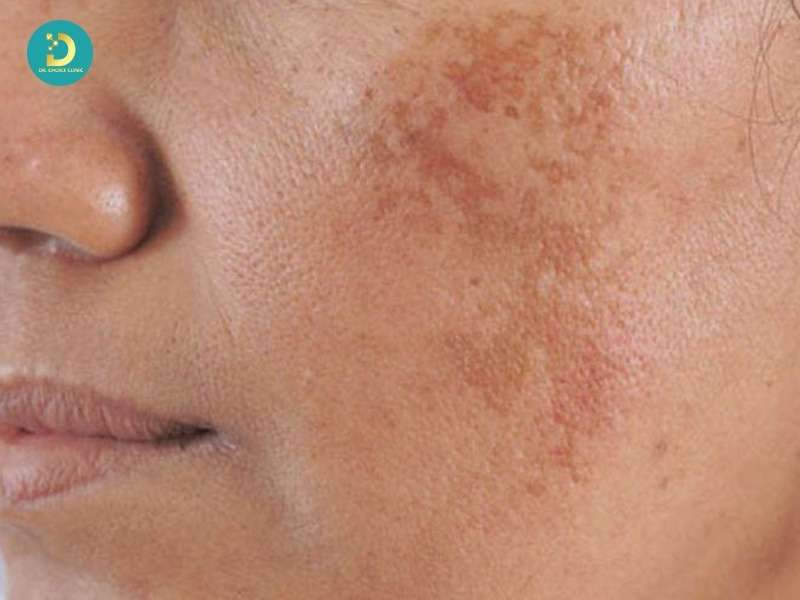 Phân Biệt Nám Da, Tàn Nhang, Đồi Mồi Như Thế Nào? 14 Nám da (Melasma)