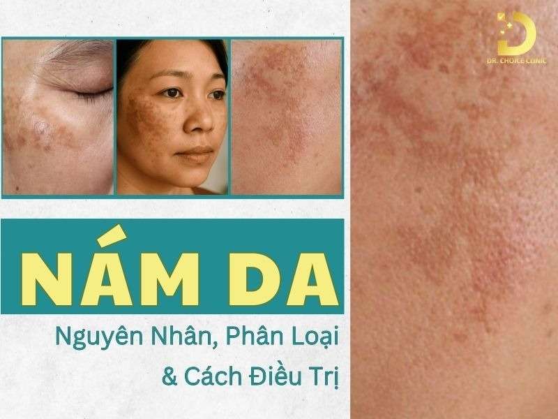 Nám Da: Nguyên Nhân, Phân Loại & Cách Điều Trị 8 Nám da