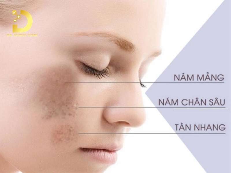Nám Nội Tiết Là Gì? Nguyên Nhân, Cách Điều Trị & Phòng Ngừa 11 Nám nội tiết là gì và làm thế nào để phân biệt với các loại nám da thông thường?