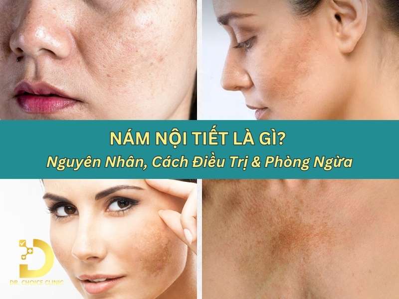 Nám Nội Tiết Là Gì? Nguyên Nhân, Cách Điều Trị & Phòng Ngừa 10 Nám nội tiết là gì?