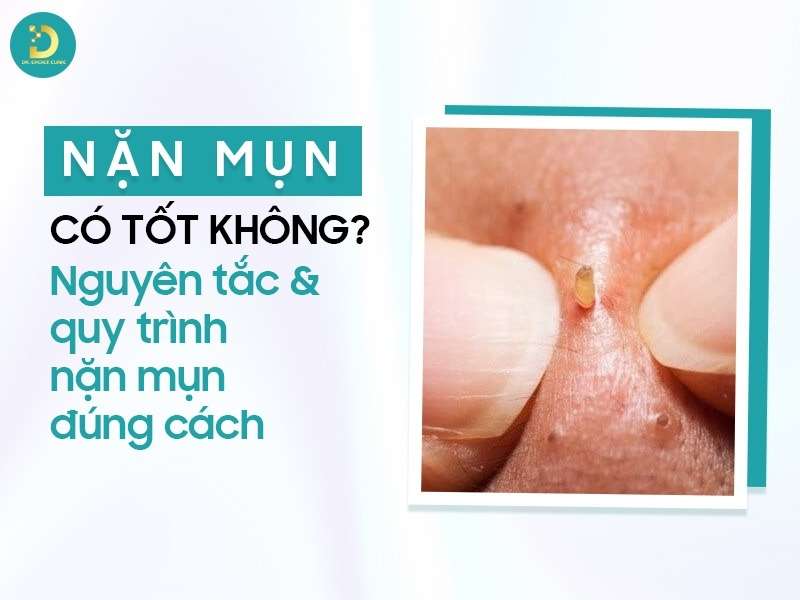 Nặn Mụn Có Tốt Không? Nguyên Tắc & Quy Trình Nặn Mụn Đúng Cách 13 Nặn mụn có tốt không?