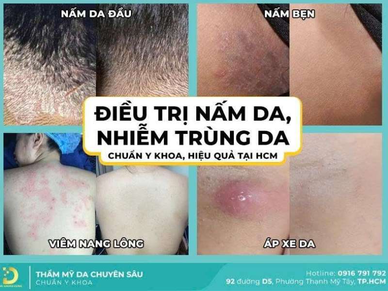 Các Loại Nấm Da Thường Gặp & Cách Điều Trị Hiệu Quả Tại Nhà 23 Nên điều trị nấm da ở đâu an toàn, hiệu quả HCM?