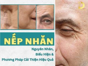 Nếp nhăn
