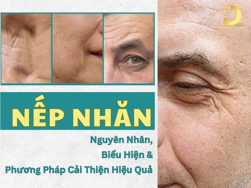 Nếp Nhăn: Nguyên Nhân, Biểu Hiện & Phương Pháp Cải Thiện Hiệu Quả 9 Nếp nhăn