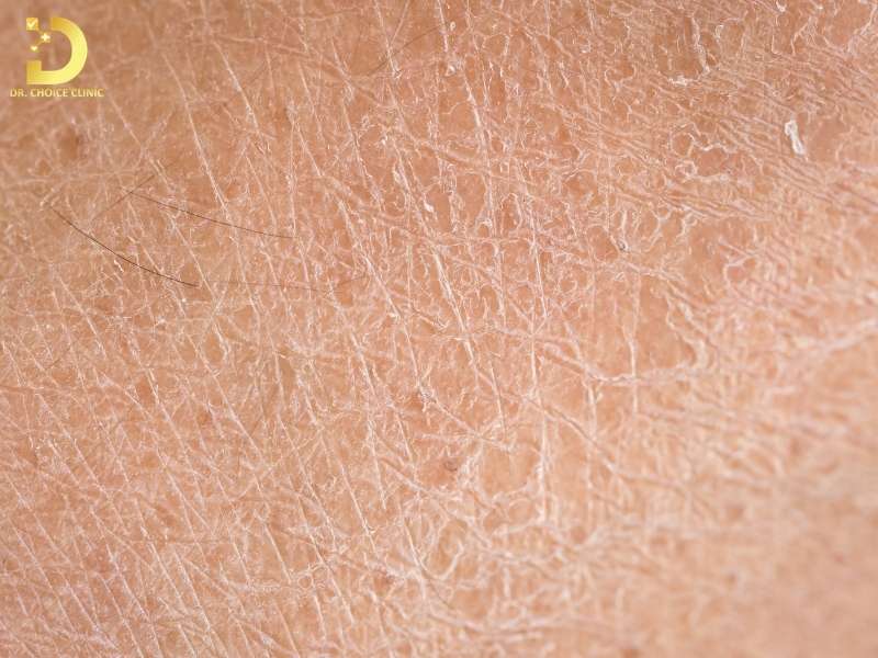 Da Khô: Nguyên Nhân, Các Vấn Đề Thường Gặp & Cách Khắc Phục 9 Nguyên nhân gây da khô là gì?