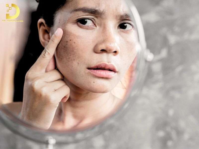 Nám Da: Nguyên Nhân, Phân Loại & Cách Điều Trị 9 Nguyên nhân hình thành nám da là gì?
