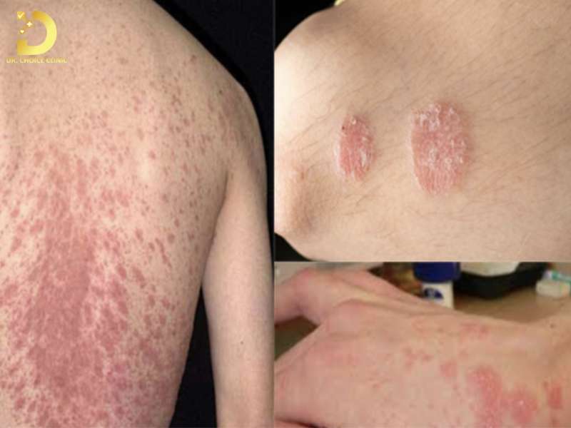 Các Loại Nấm Da Thường Gặp & Cách Điều Trị Hiệu Quả Tại Nhà 14 Nguyên nhân hình thành nấm da là gì?