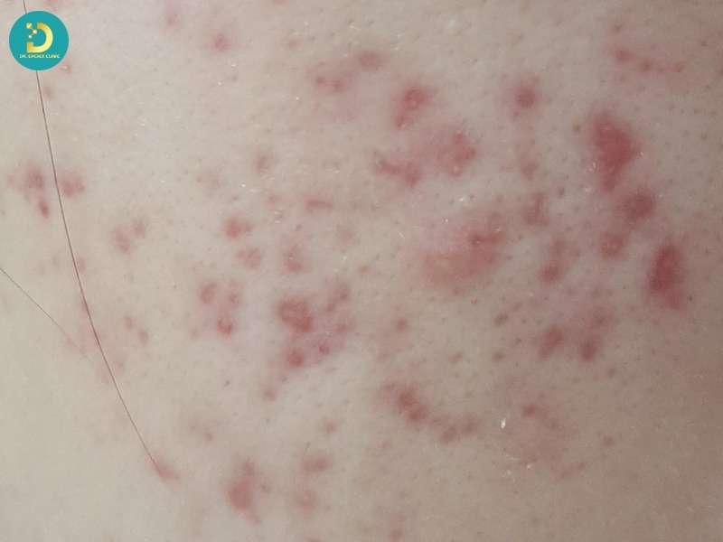 Thâm Đỏ (Hồng Ban Sau Viêm): Nguyên Nhân & Cách Điều Trị Hiệu Quả 13 Nguyên nhân phổ biến gây thâm đỏ sau viêm thường bắt đầu từ những tổn thương quen thuộc này
