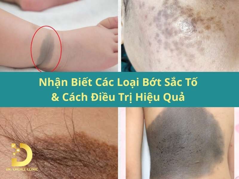 Nhận Biết Các Loại Bớt Sắc Tố & Cách Điều Trị Hiệu Quả 8 Nhận biết các loại bớt sắc tố & cách điều trị