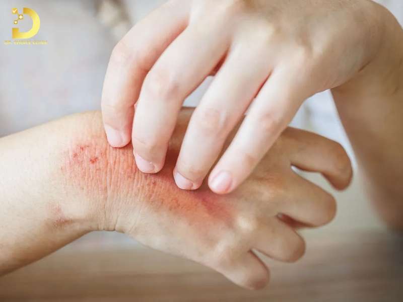 Các Loại Nấm Da Thường Gặp & Cách Điều Trị Hiệu Quả Tại Nhà 22 Những sai lầm thường gặp khi điều trị nấm da tại nhà