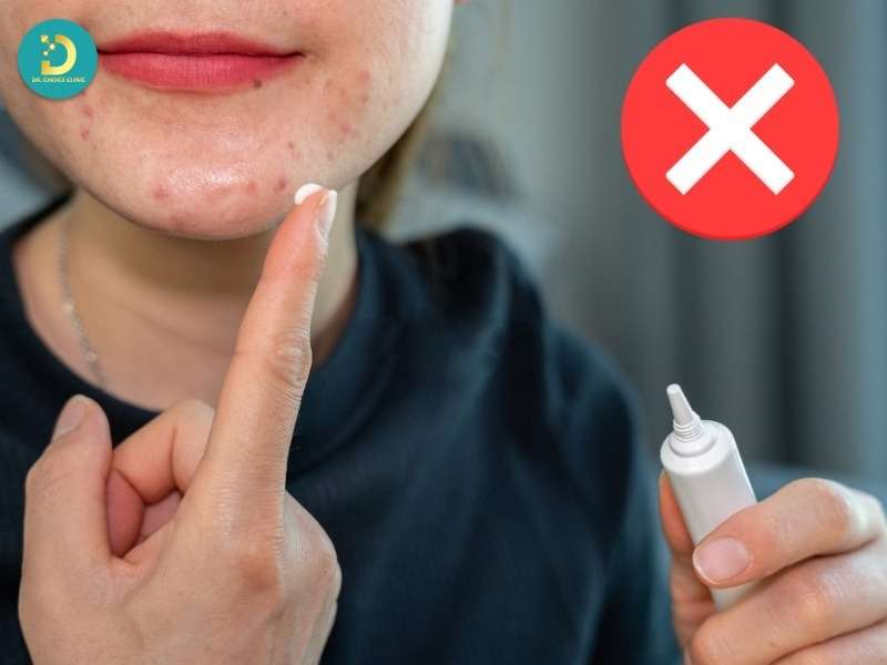 Kem Trị Mụn Là Gì? Đặc Điểm, Cách Dùng & Top Sản Phẩm 15 Những sai lầm thường gặp khi dùng kem trị mụn