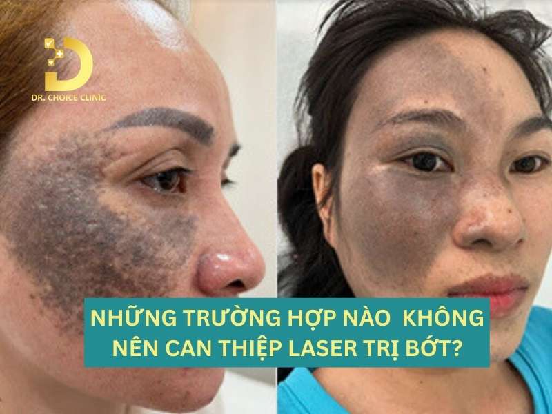 Nhận Biết Các Loại Bớt Sắc Tố & Cách Điều Trị Hiệu Quả 12 Những trường hợp nào bác sĩ khuyến cáo tạm hoãn hoặc không nên can thiệp Laser?