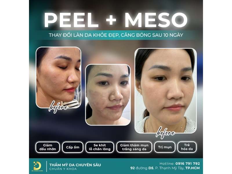Top Cách Xóa Nhăn Vùng Da Quanh Mắt Hiệu Quả Tại Nhà 21 Địa chỉ nào xóa nhăn vùng da quanh mắt an toàn, hiệu quả tại HCM?