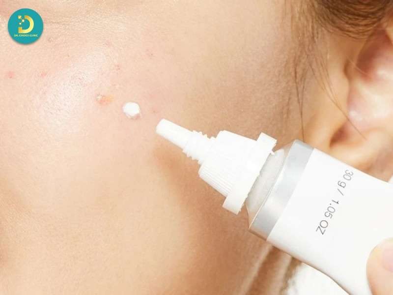 Kem Trị Mụn Là Gì? Đặc Điểm, Cách Dùng & Top Sản Phẩm 11 Phân biệt kem trị mụn với các sản phẩm trị mụn khác