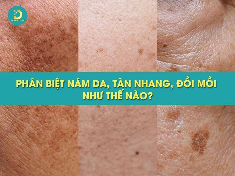 Phân Biệt Nám Da, Tàn Nhang, Đồi Mồi Như Thế Nào? 11 Phân biệt nám da, tàn nhang, đồi mồi