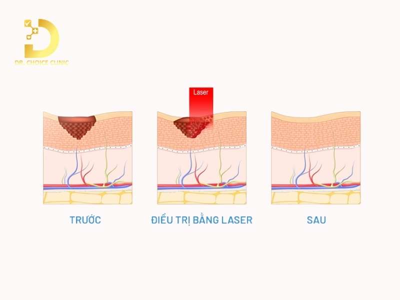 Nhận Biết Các Loại Bớt Sắc Tố & Cách Điều Trị Hiệu Quả 11 Phương pháp điều trị bớt sắc tố nào mang lại hiệu quả cao?