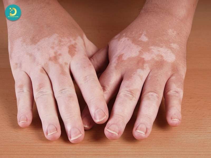 Rối Loạn Sắc Tố Da: Nguyên Nhân, Các Loại & Cách Điều Trị Hiệu Quả 17 Rối loạn mất sắc tố da