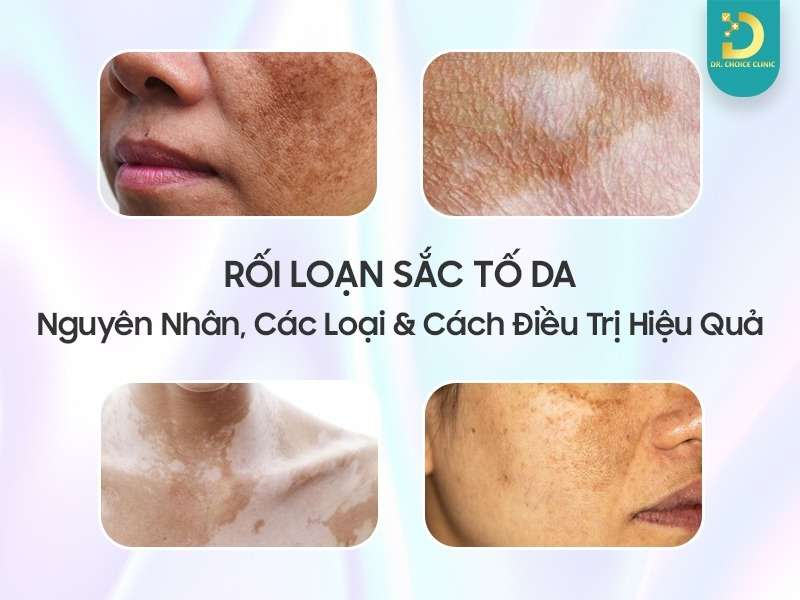 Rối Loạn Sắc Tố Da: Nguyên Nhân, Các Loại & Cách Điều Trị Hiệu Quả 13 Rối loạn sắc tố da