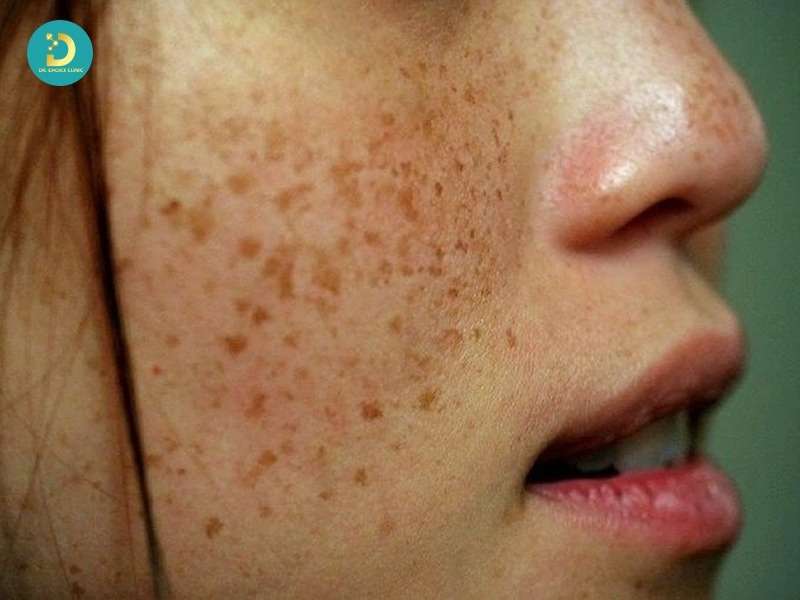 Phân Biệt Nám Da, Tàn Nhang, Đồi Mồi Như Thế Nào? 13 Tàn nhang (Freckles)