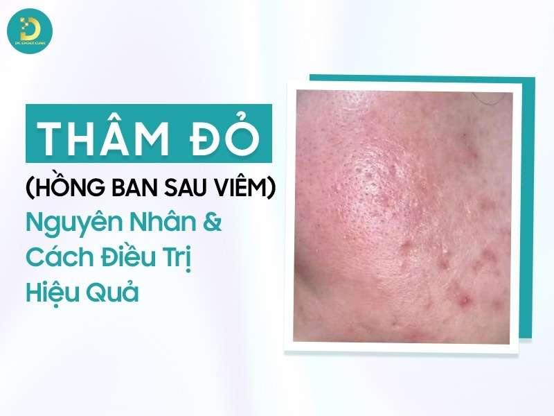 Thâm Đỏ (Hồng Ban Sau Viêm): Nguyên Nhân & Cách Điều Trị Hiệu Quả 11 Thâm đỏ (hồng ban sau viêm)
