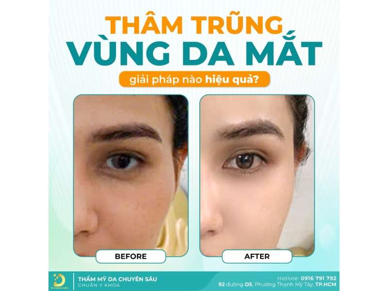 Top Cách Xóa Nhăn Vùng Da Quanh Mắt Hiệu Quả Tại Nhà 20 Địa chỉ nào xóa nhăn vùng da quanh mắt an toàn, hiệu quả tại HCM?