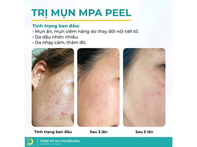 Thâm Đỏ (Hồng Ban Sau Viêm): Nguyên Nhân & Cách Điều Trị Hiệu Quả 19 Trị thâm đỏ (hồng ban sau viêm) ở đâu uy tín, hiệu quả tại HCM?