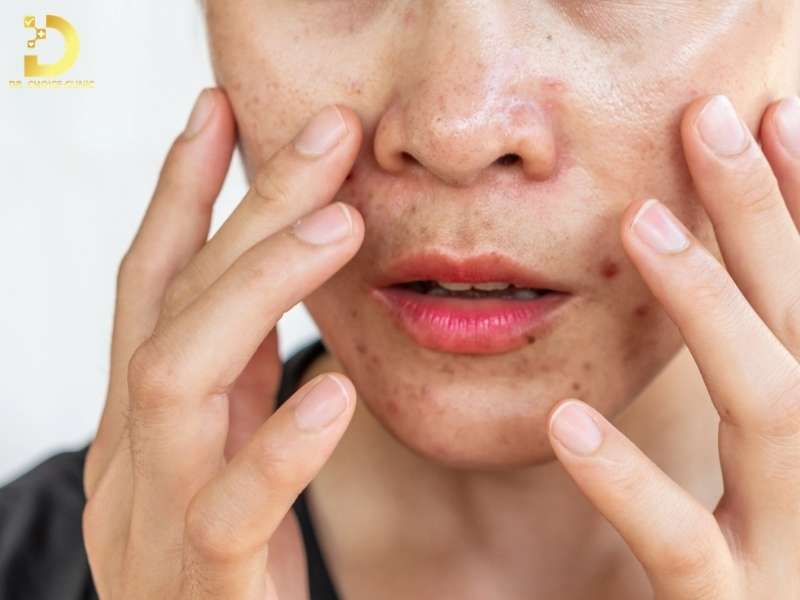 Da Hỗn Hợp Là Gì? Đặc Điểm, Phân Loại & Cách Chăm Sóc 13 Các vấn đề thường gặp ở da hỗn hợp