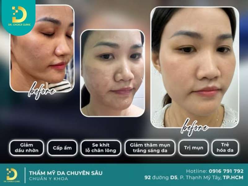 Top Mặt Nạ Trị Thâm Tại Nhà Hiệu Quả Bạn Không Nên Bỏ Qua 15 Đơn vị nào điều trị thâm da hiệu quả, uy tín tại TP. Hồ Chí Minh?