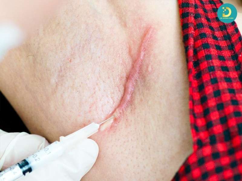 Sẹo Lồi Đỏ Và Ngứa: Nguyên Nhân & Cách Điều Trị Hiệu Quả 14 Các phương pháp phối hợp bổ trợ