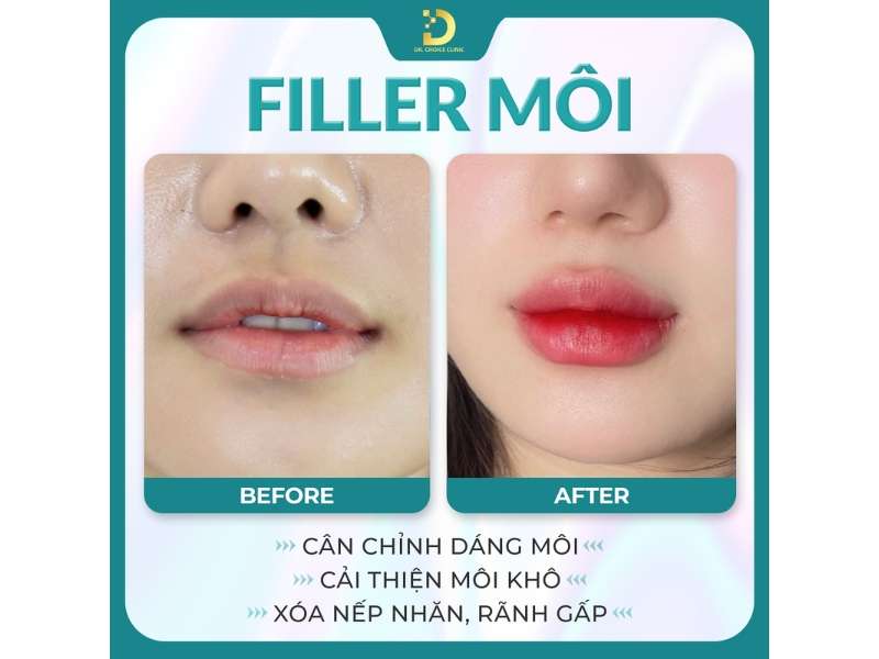Tiêm Filler Và Botox Khác Nhau Như Thế Nào? Lưu Ý Lựa Chọn 20 Filler môi cân chỉnh dáng môi, cải thiện môi khô, xóa nếp nhăn, rãnh gấp