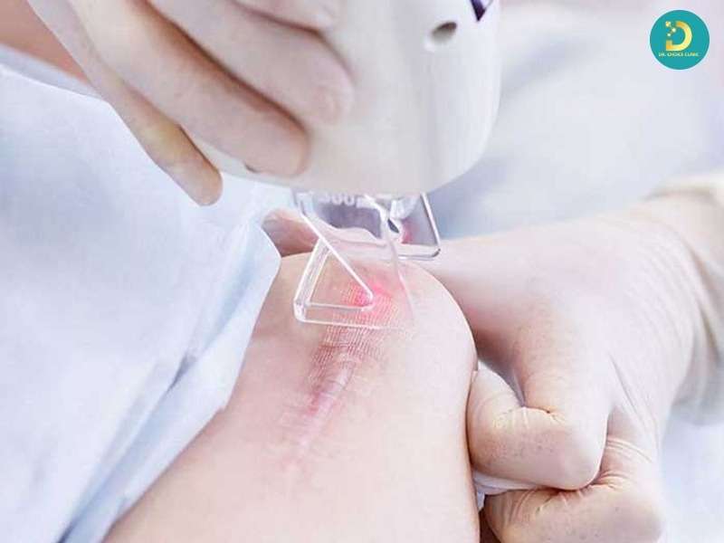 Sẹo Lồi Đỏ Và Ngứa: Nguyên Nhân & Cách Điều Trị Hiệu Quả 13 Liệu trình điều trị sẹo lồi đỏ 4IN1 (Nội khoa chuyên sâu)
