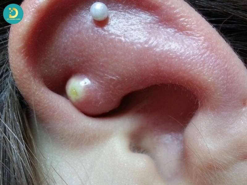 Sẹo Lồi Vành Tai: Nguyên Nhân, Cách Điều Trị & Phòng Ngừa Hiệu Quả 9 Nguyên nhân gây sẹo lồi vành tai là gì?