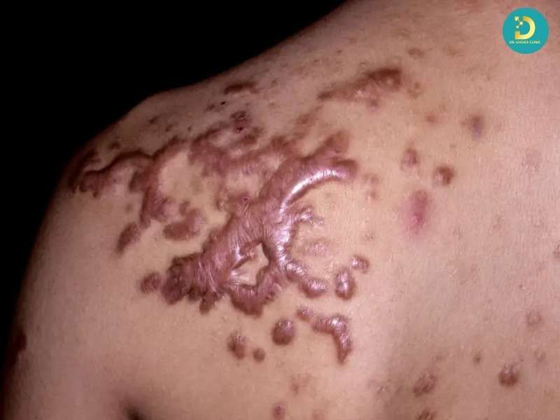 Sẹo Lồi Đỏ Và Ngứa: Nguyên Nhân & Cách Điều Trị Hiệu Quả 11 Nguyên nhân hình thành