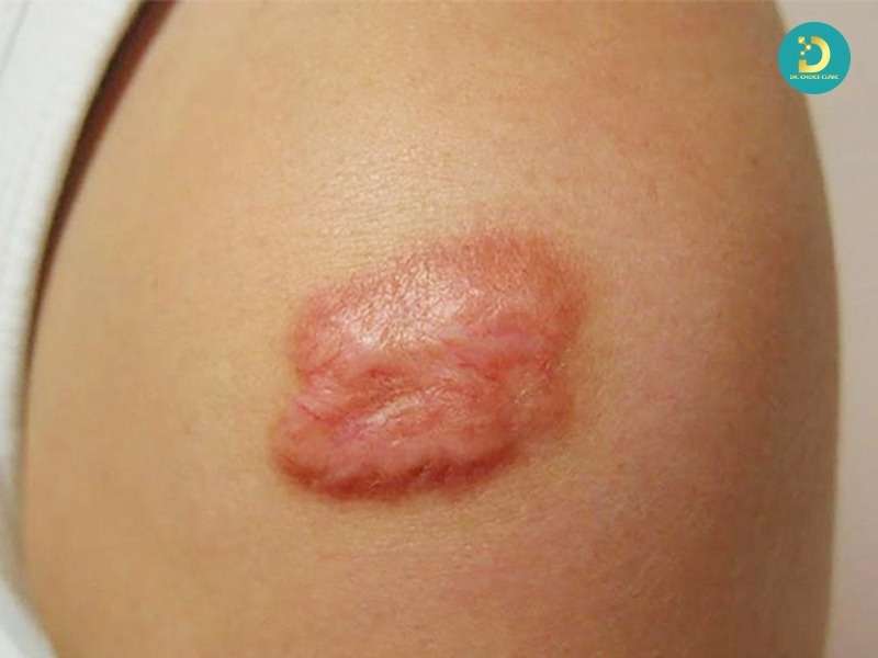 Sẹo Lồi Đỏ Và Ngứa: Nguyên Nhân & Cách Điều Trị Hiệu Quả 10 Sẹo lồi đỏ và ngứa là gì? có nguy hiểm không?