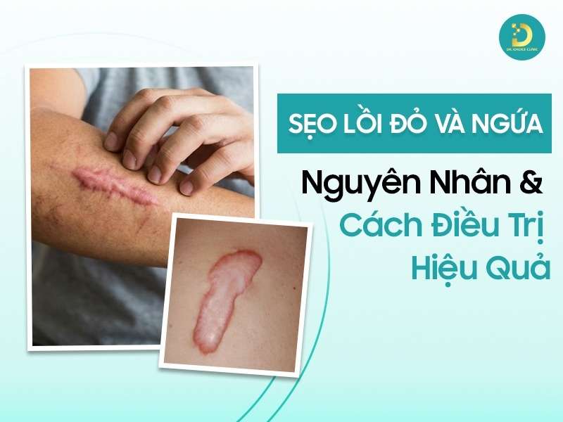 Sẹo Lồi Đỏ Và Ngứa: Nguyên Nhân & Cách Điều Trị Hiệu Quả 9 Sẹo lồi đỏ và ngứa