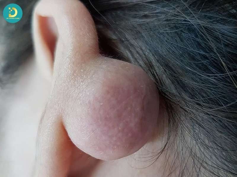 Sẹo Lồi Vành Tai: Nguyên Nhân, Cách Điều Trị & Phòng Ngừa Hiệu Quả 8 Sẹo lồi vành tai là gì? hiểu đúng để điều trị hiệu quả