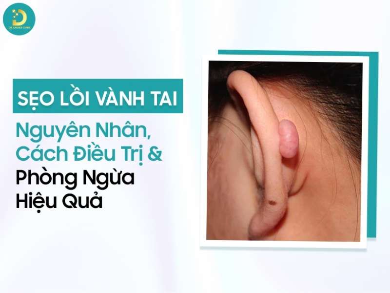 Sẹo Lồi Vành Tai: Nguyên Nhân, Cách Điều Trị & Phòng Ngừa Hiệu Quả 7 Sẹo lồi vành tai