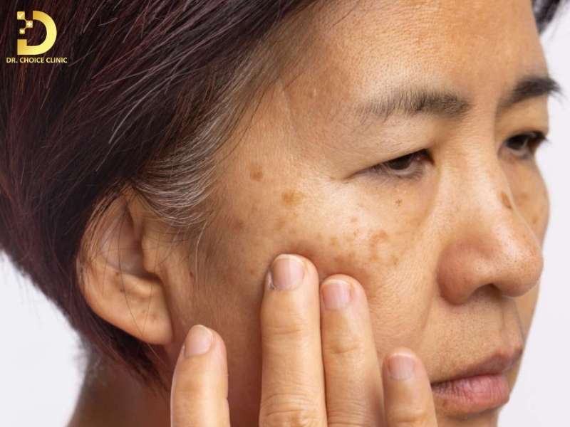 Tàn Nhang Bẩm Sinh Là Gì? Dấu Hiệu, Nguyên Nhân & Cách Điều Trị 13 Tàn nhang bẩm sinh là gì? góc nhìn da liễu về rối loạn sắc tố di truyền