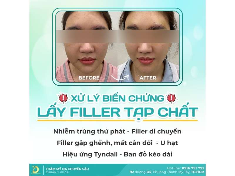 Tiêm Filler Và Botox Khác Nhau Như Thế Nào? Lưu Ý Lựa Chọn 19 Xử lý biến chứng lấy filler tạp chất