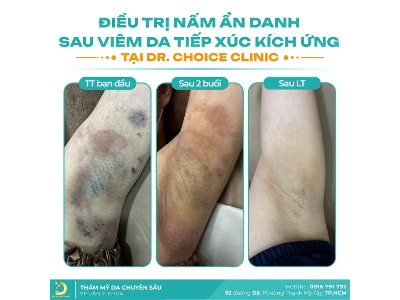 Phòng Khám Điều Trị Nấm Thân Mình Uy Tín, Hiệu Quả HCM 13 Chi phí điều trị nấm thân mình tại Dr. Choice Clinic như thế nào?