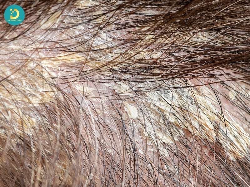 Phòng Khám Điều Trị Nấm Da Đầu Ở TP.HCM Uy Tín, Hiệu Quả 11 Cơ chế gây bệnh của vi nấm