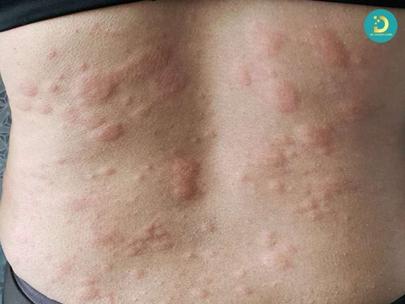 Phòng Khám Trị Mề Đay Hiệu Quả, An Toàn Tại TP.HCM 12 Cơ chế gây mề đay – vai trò của histamin và tế bào mast