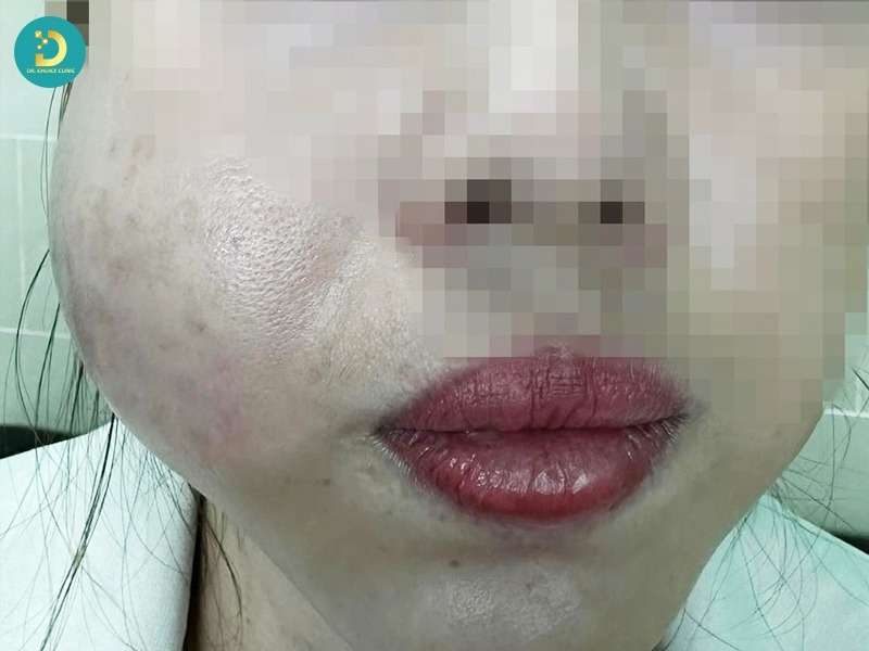 Phòng Khám Xử Lý Filler Sai Cách Ở TP. HCM An Toàn, Hiệu Quả 10 Dấu hiệu nhận biết filler sai cách là gì? khi nào cần xử lý ngay?