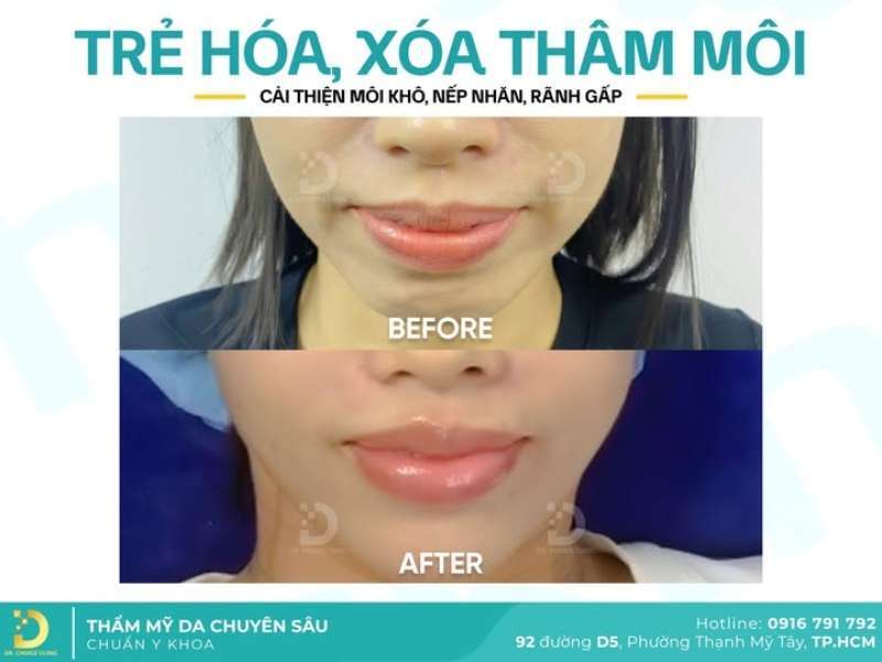 Phòng Khám Xóa Nếp Nhăn & Rãnh Sâu Uy Tín, Hiệu Quả Tại TP.HCM 13 Feedback từ khách hàng đã xóa nếp nhăn