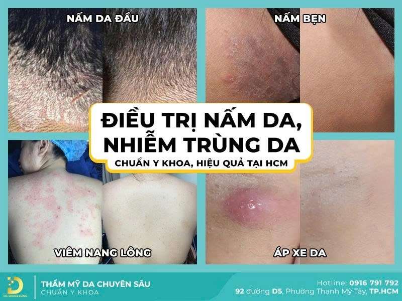 Phòng Khám Điều Trị Nấm Thân Mình Uy Tín, Hiệu Quả HCM 12 Quy trình điều trị nấm thân mình tại Dr. Choice Clinic