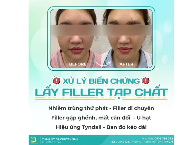 Phòng Khám Xử Lý Filler Sai Cách Ở TP. HCM An Toàn, Hiệu Quả 15 Lý do gì Dr. Choice được nhiều khách hàng lựa chọn?