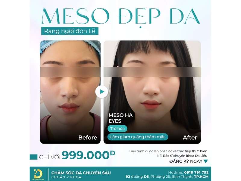 Phòng Khám Tái Tạo Da Căng Bóng & Phục Hồi Hiệu Quả Tại TP.HCM 21 meso chăm da đón lễ