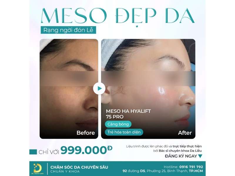 Phòng Khám Tái Tạo Da Căng Bóng & Phục Hồi Hiệu Quả Tại TP.HCM 19 meso đẹp da rạng ngời đón lễ