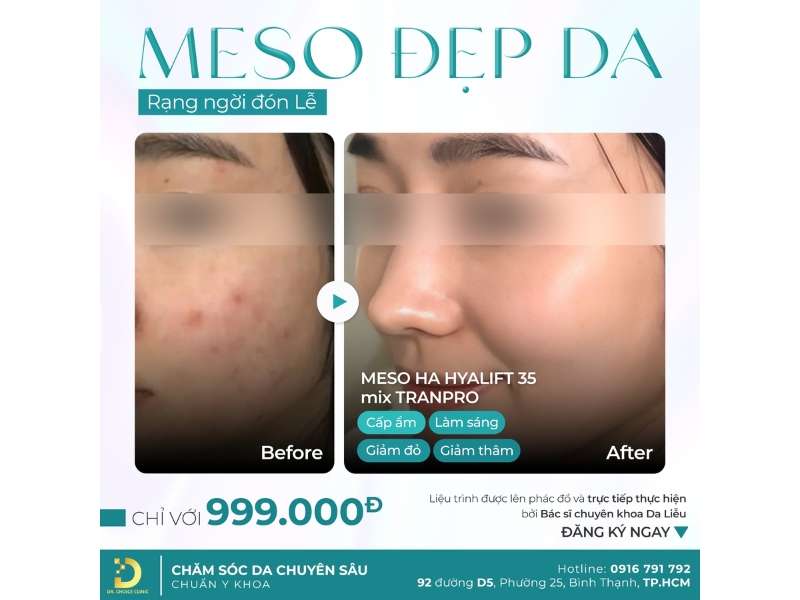 Phòng Khám Tái Tạo Da Căng Bóng & Phục Hồi Hiệu Quả Tại TP.HCM 18 meso đẹp da