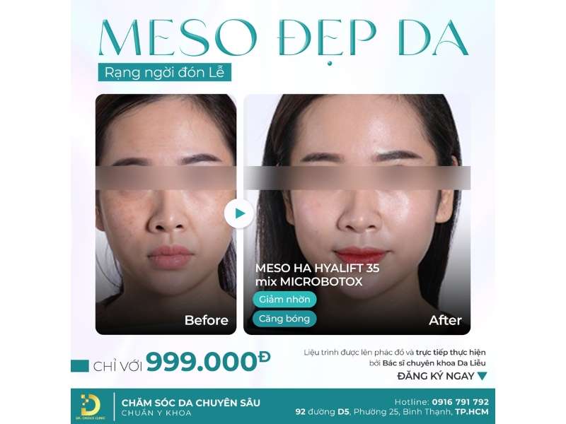 Phòng Khám Tái Tạo Da Căng Bóng & Phục Hồi Hiệu Quả Tại TP.HCM 20 meso làm đẹp da đón lễ